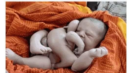 होना था जुड़वा बच्चों का जन्म मगर एक में जुड़ गए दूसरे के हाथ- पैर…… जानिए पूरा मामला