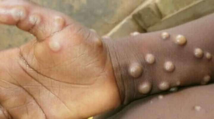 उपलब्धि -: वैज्ञानिकों ने ढूंढ निकाला मंकीपॉक्स का जिंदा वायरस