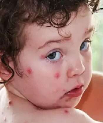 स्वास्थ्य मंत्रालय ने टमाटर फ्लू पर जारी की एडवाइजरी…. कही यह बातें