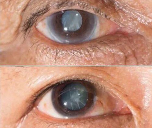 अल्मोड़ा -: निशुल्क मोतियाबिंद के ऑपरेशन शुरू