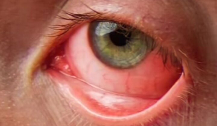 Uttarakhand- राज्य के इन क्षेत्रों में तेजी से फैल रहा आई फ्लू…… शिक्षा विभाग ने जारी की गाइडलाइन